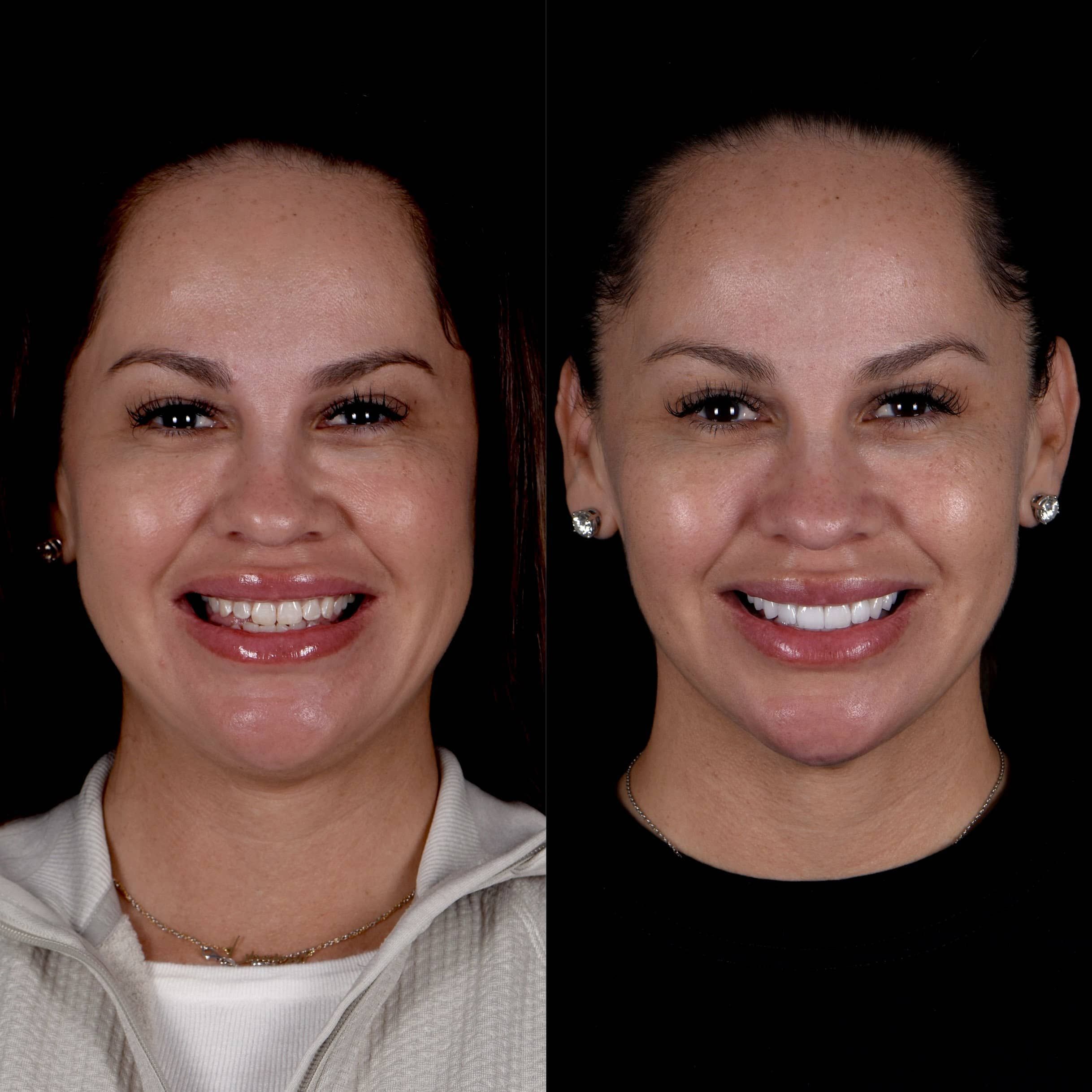 Gallery Before and After Dental Veneers in Los Angeles, CA Smiles By
