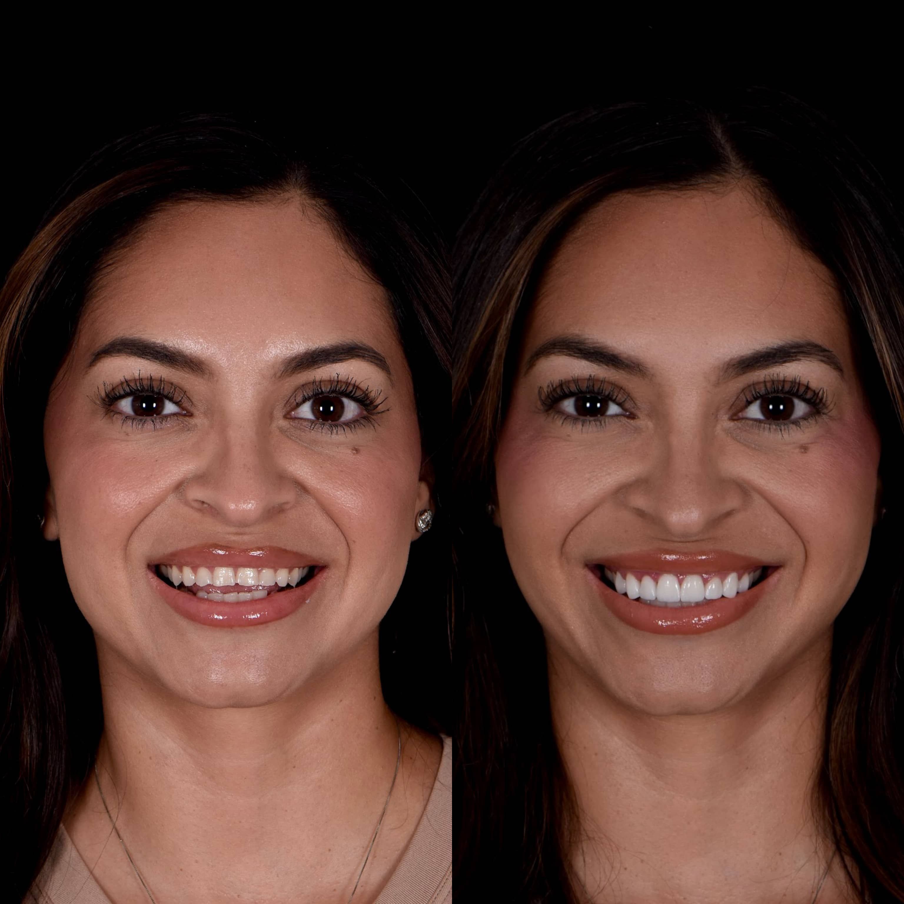 Before and after of veneers procedure by dentist in LA