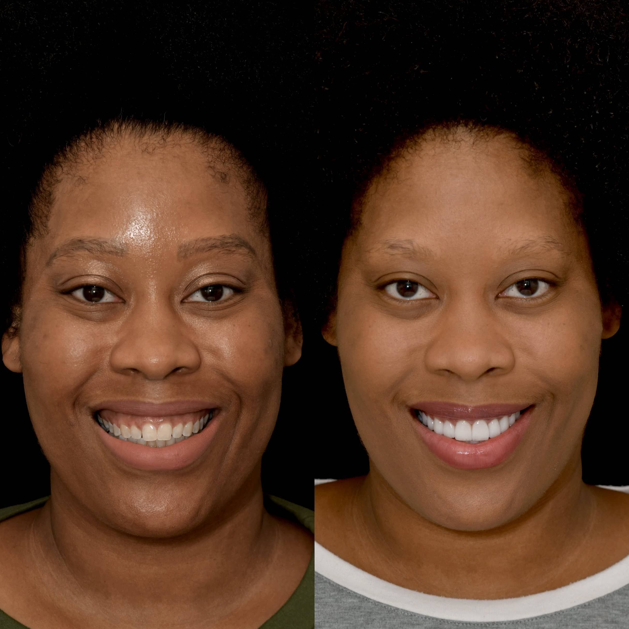 Before and after of veneers procedure by dentist in Beverly Hills