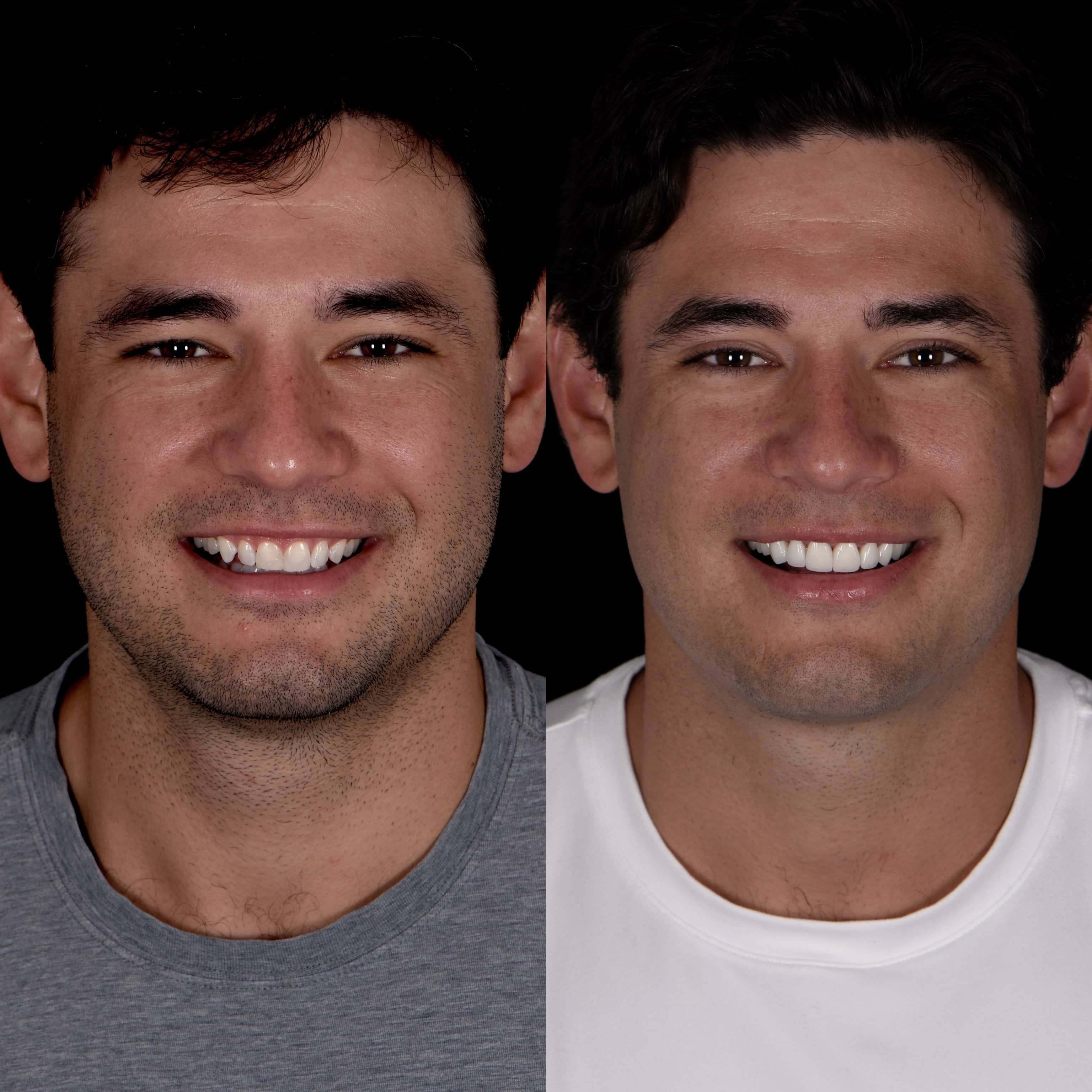 Beverly Hills patient smiling with new porcelain veneers