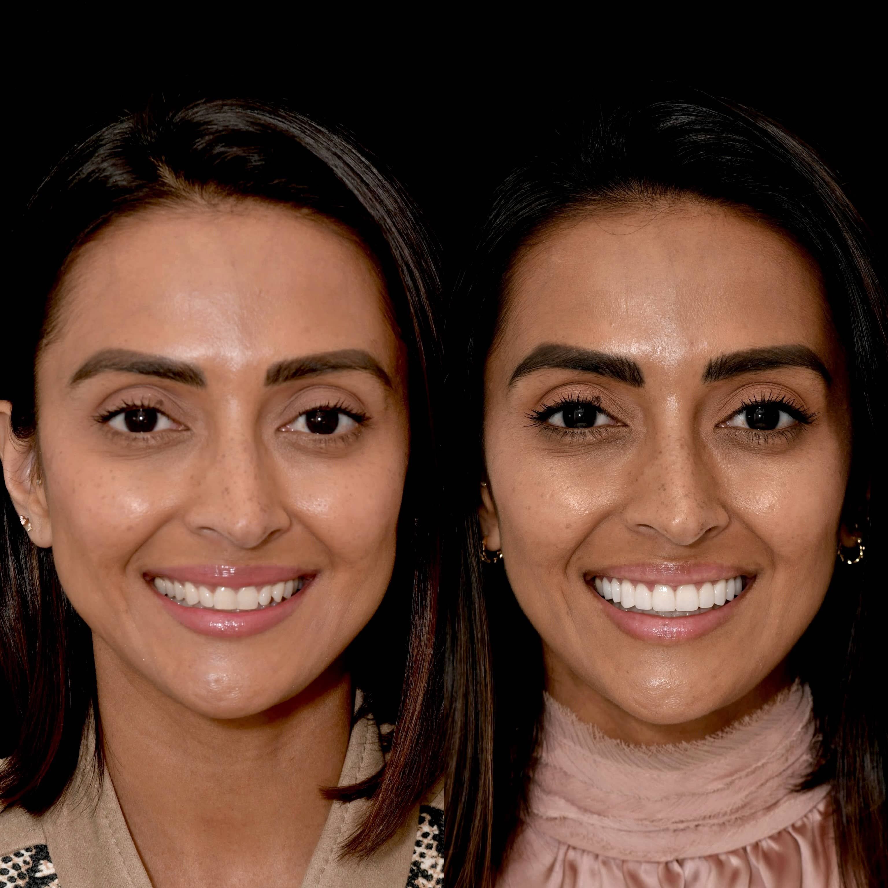 Beautiful smile transformations with veneers in Beverly Hills