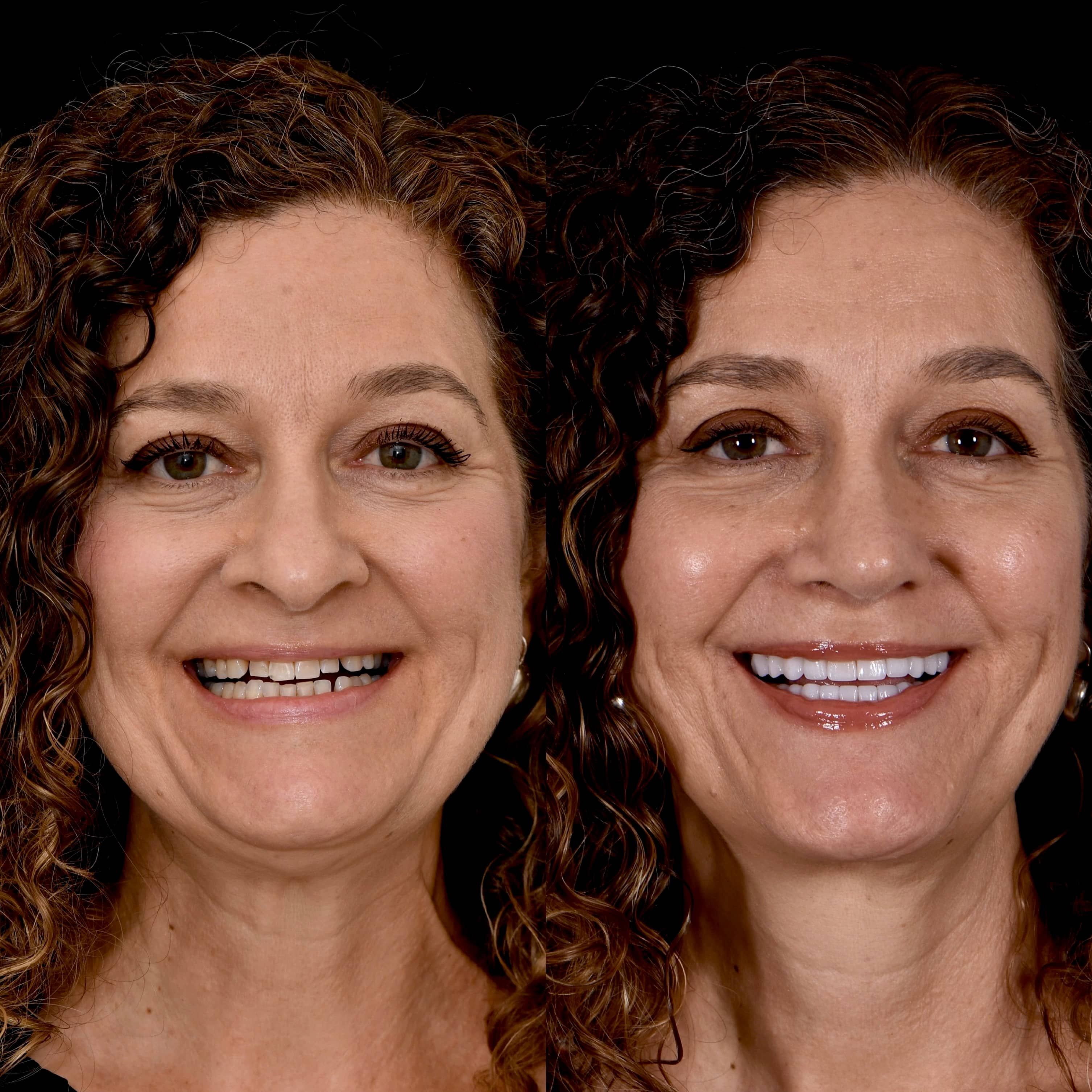 Detailed veneers process at Los Angeles cosmetic dental practice