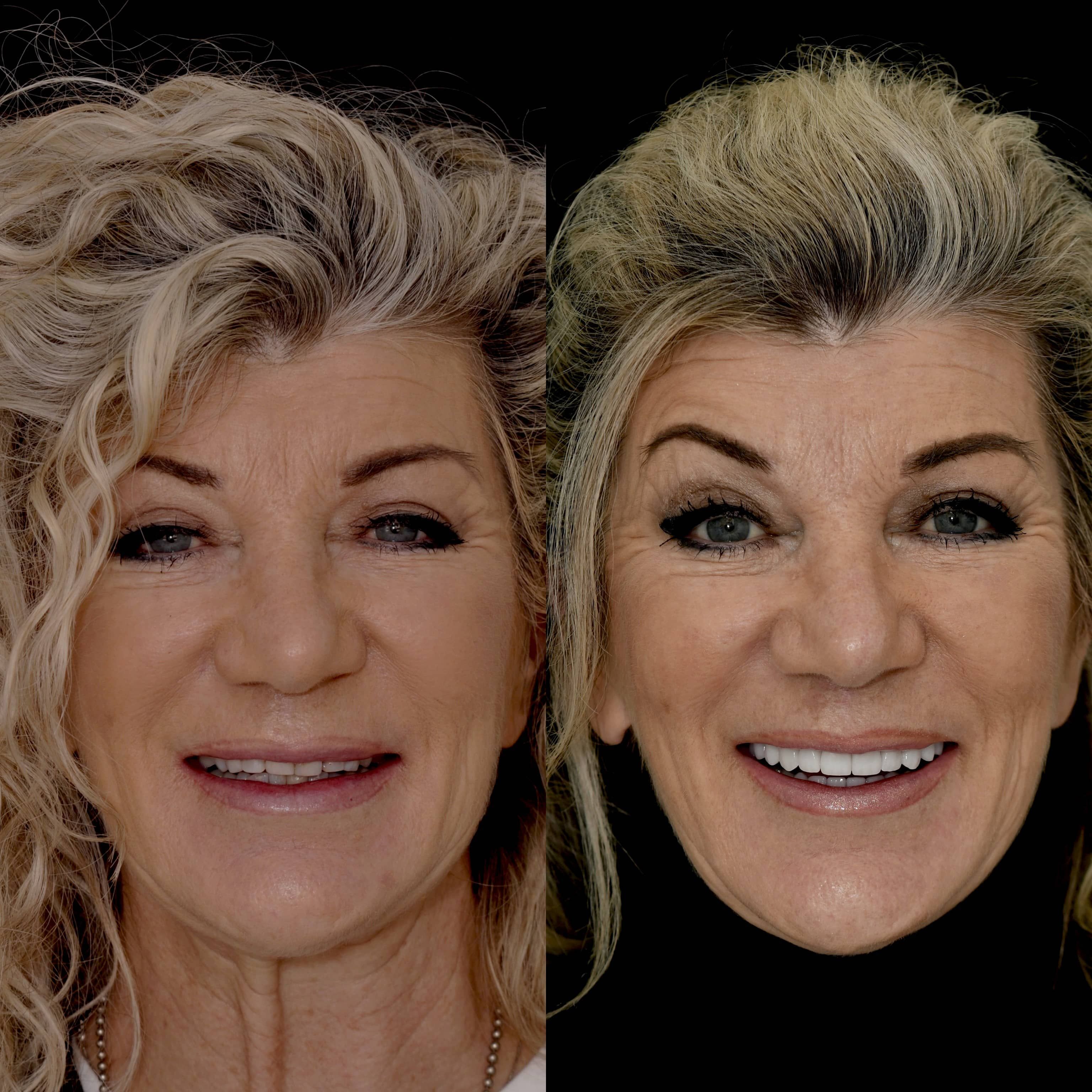 State-of-the-art veneers results in Beverly Hills dentist