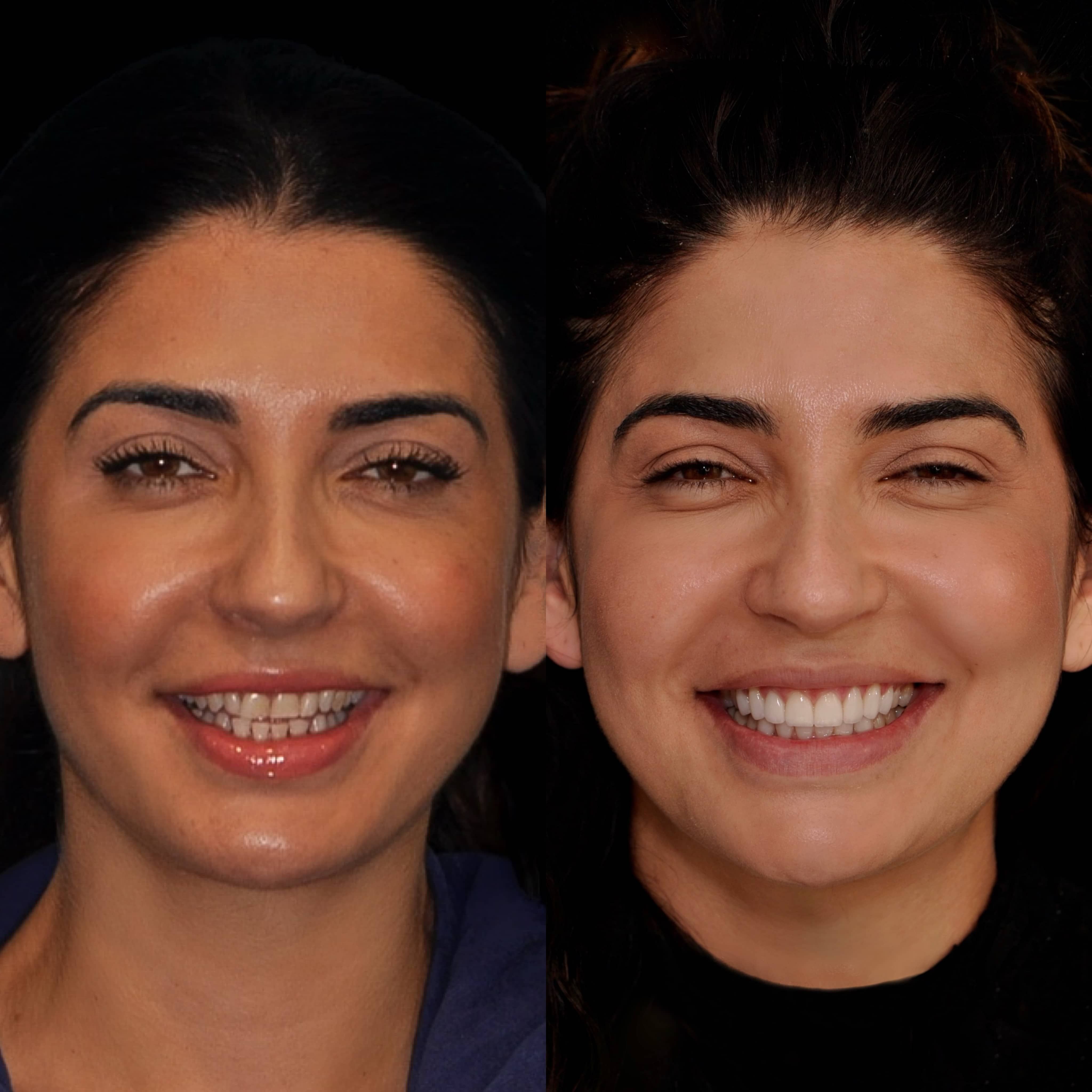 Smiling patient with veneers at Los Angeles cosmetic dentist