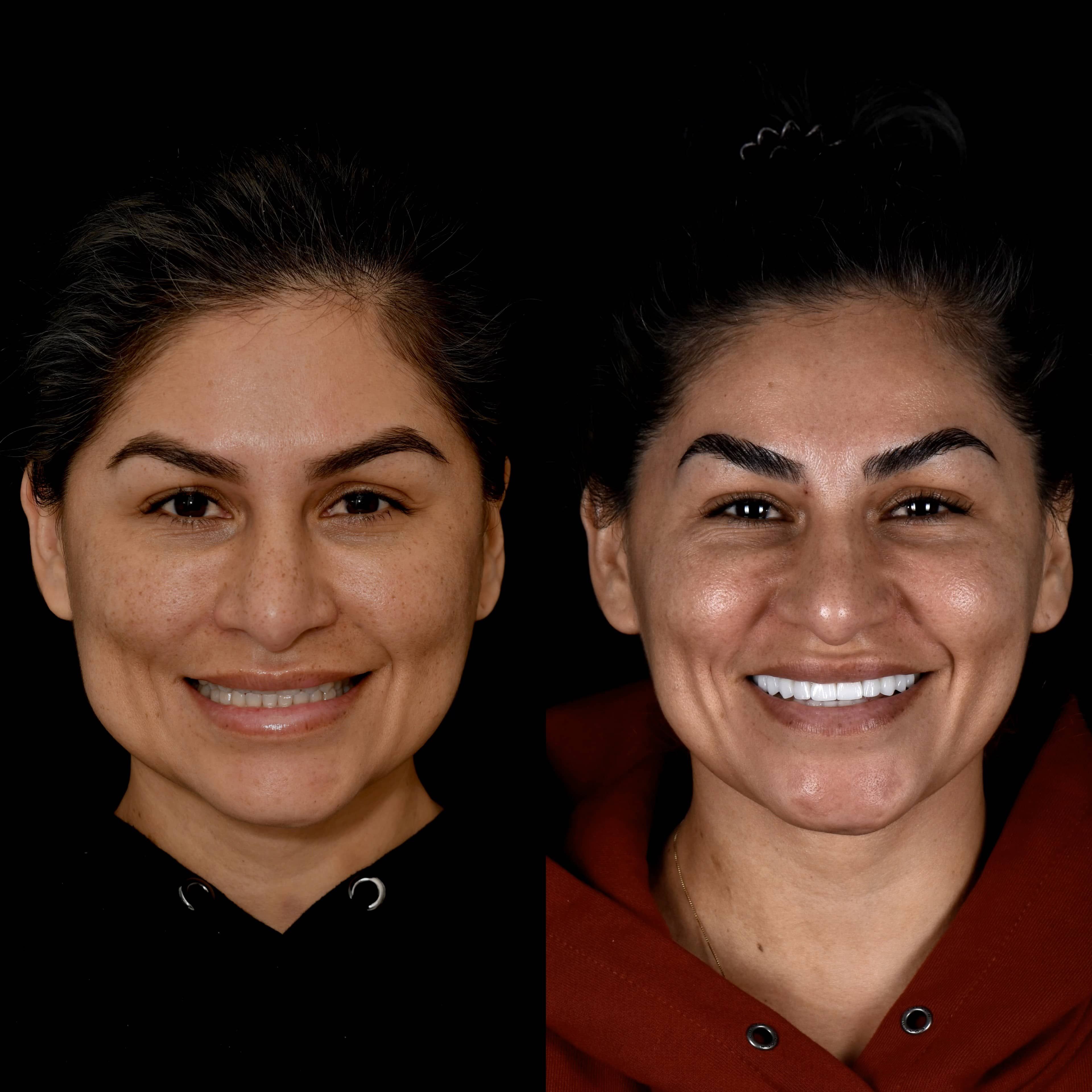 Patient consultation for veneers in a Beverly Hills dentist