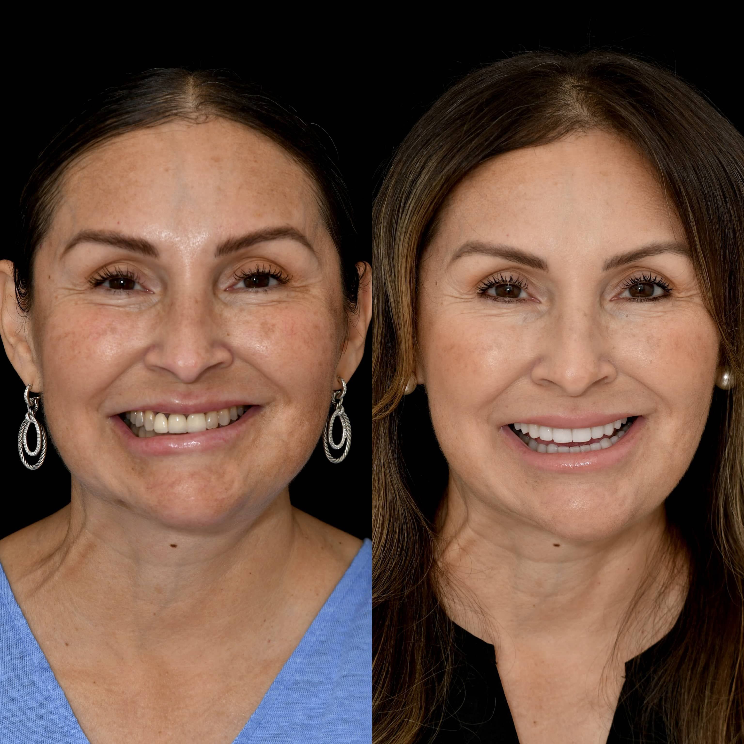 Close-up of veneers results in Beverly Hills
