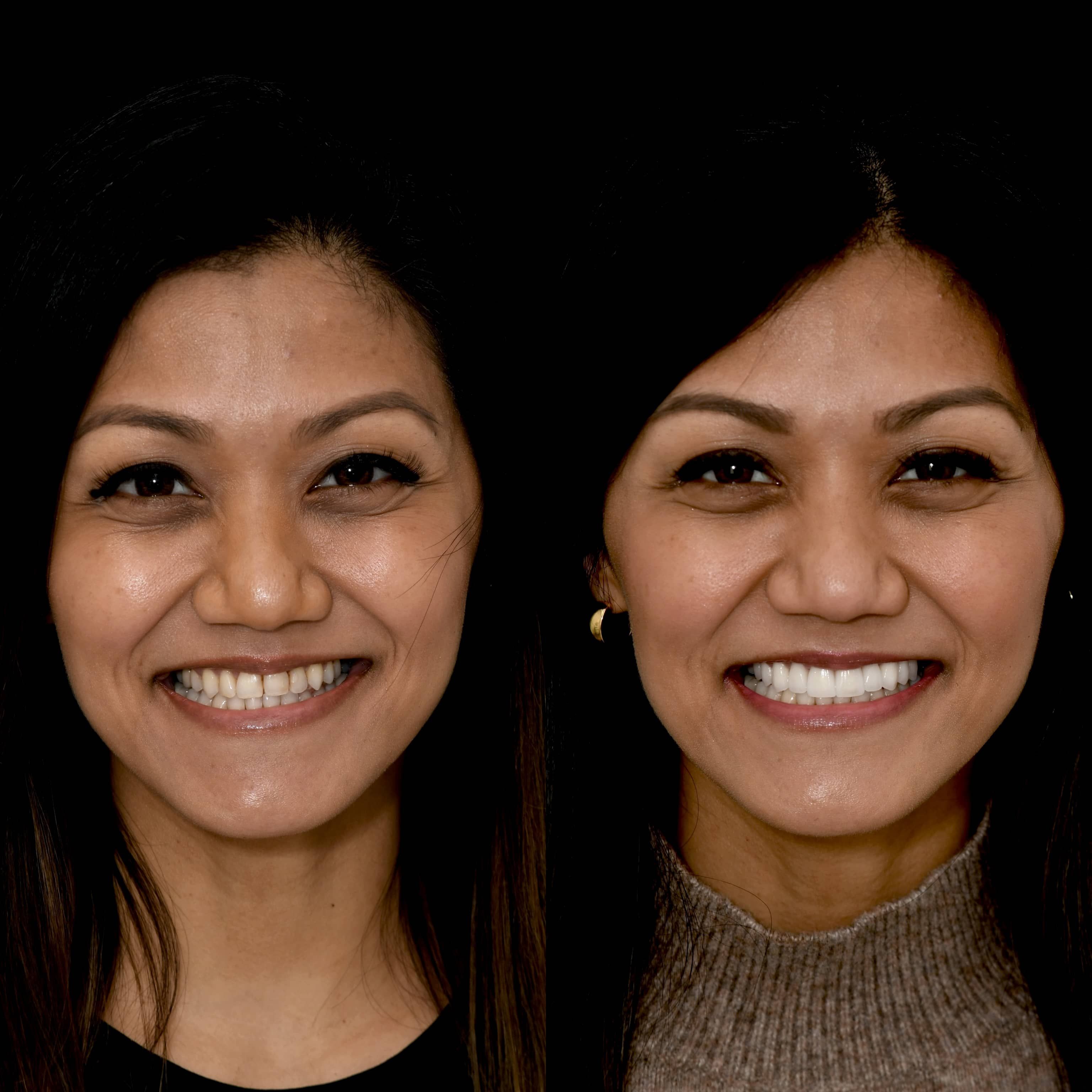 Smiling patient with veneers at LA cosmetic dentist