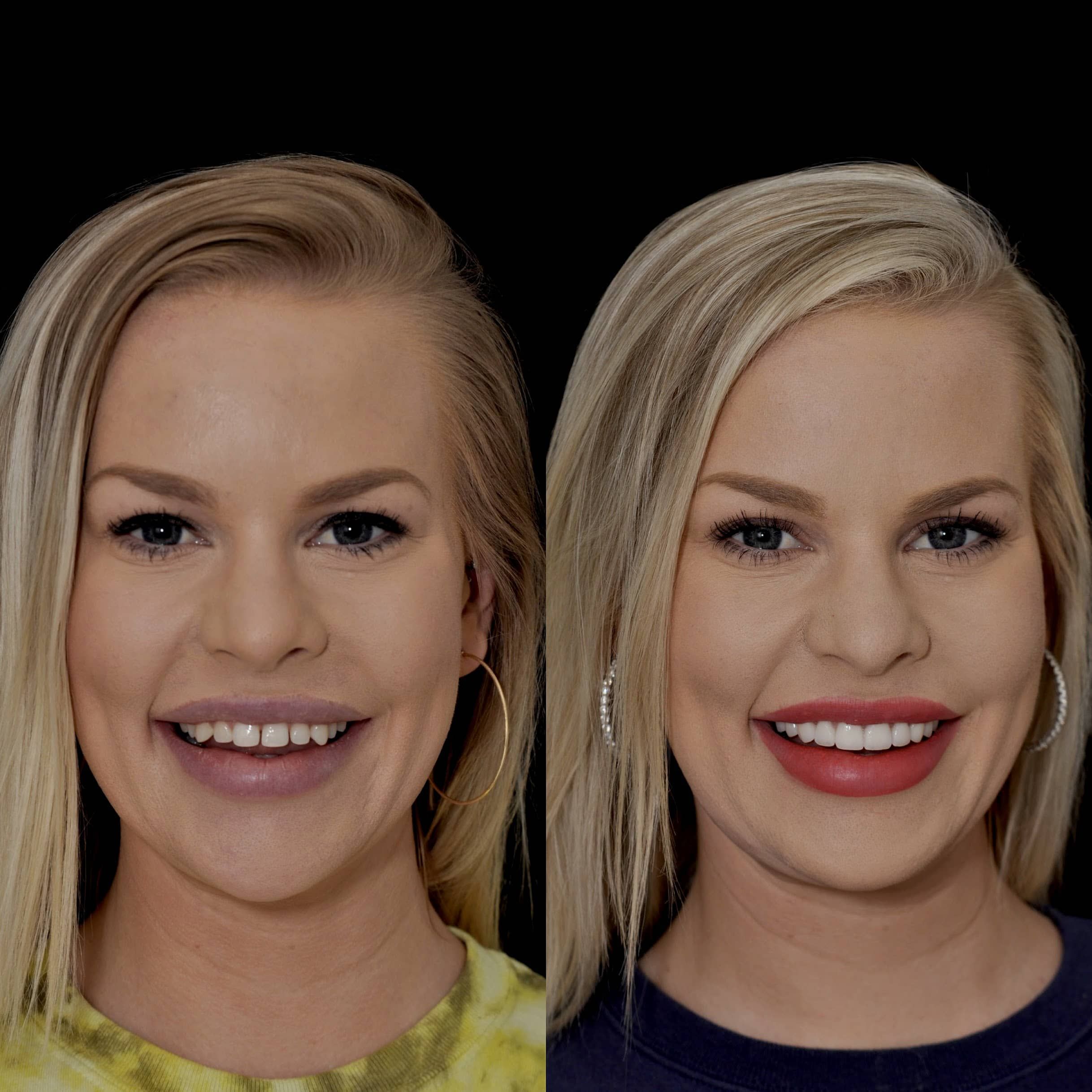 Woman showing teeth before and after treatment