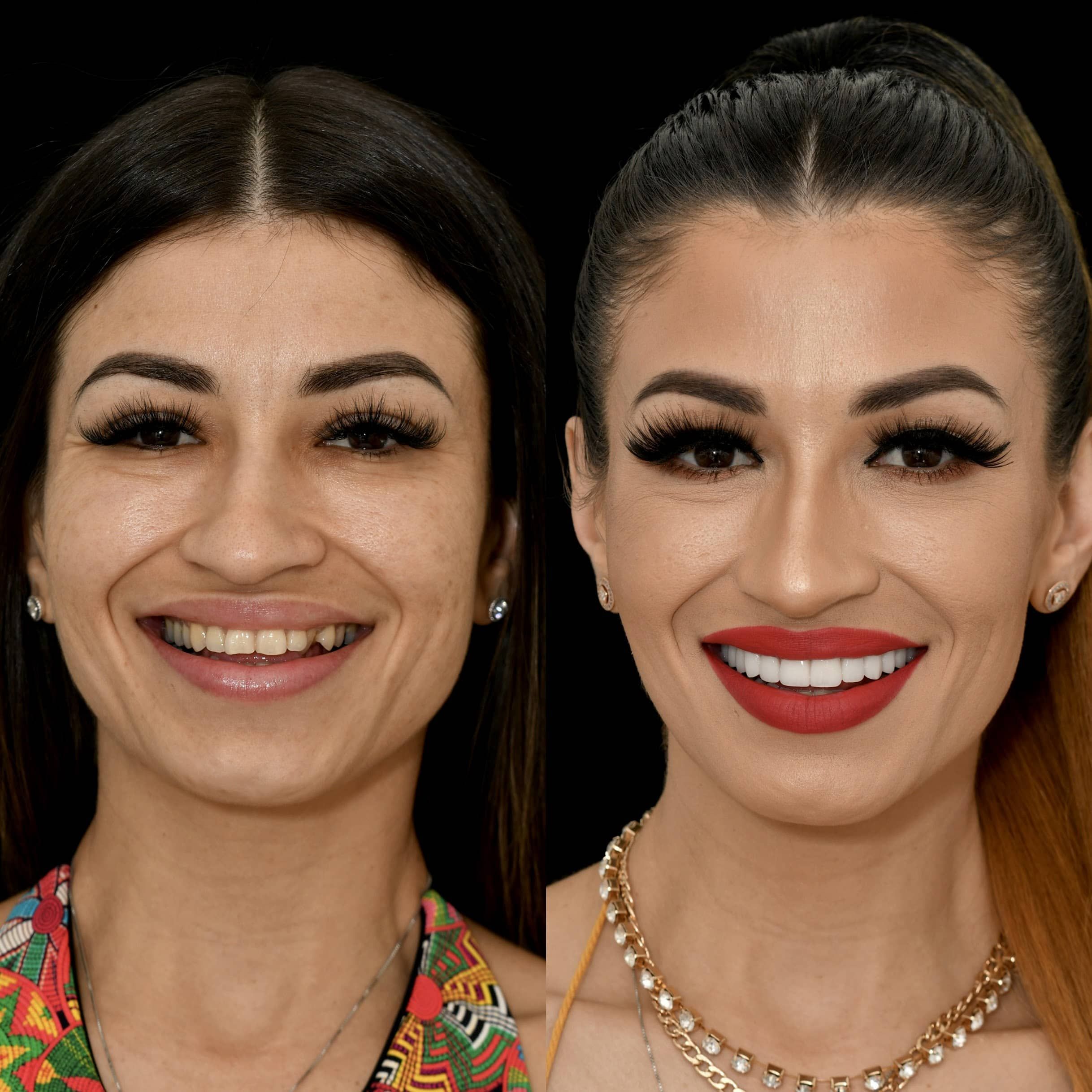 Woman showing teeth before and after treatment