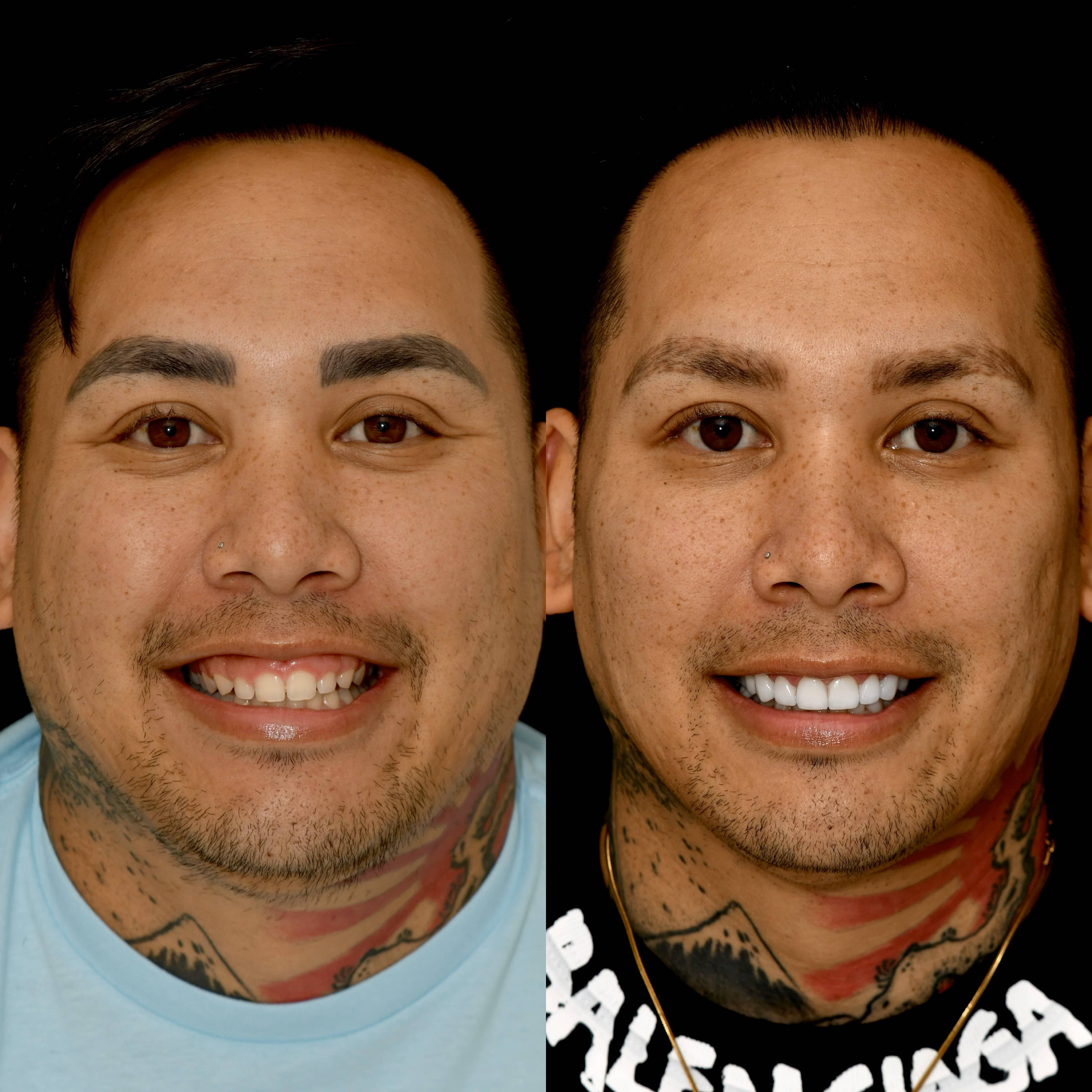 Veneers Beverly Hills - Real Patient Photo Results