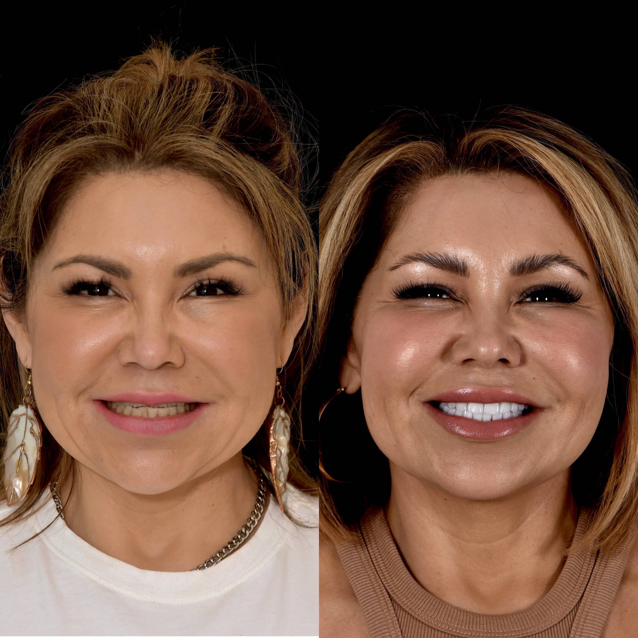 Los Angeles cosmetic dentist smile makeover before and after