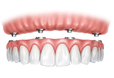 all-on-4 dentures