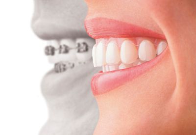 wired braces versus invisalign