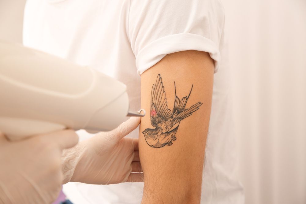 How Do You Treat Skin After Laser Tattoo Removal?
