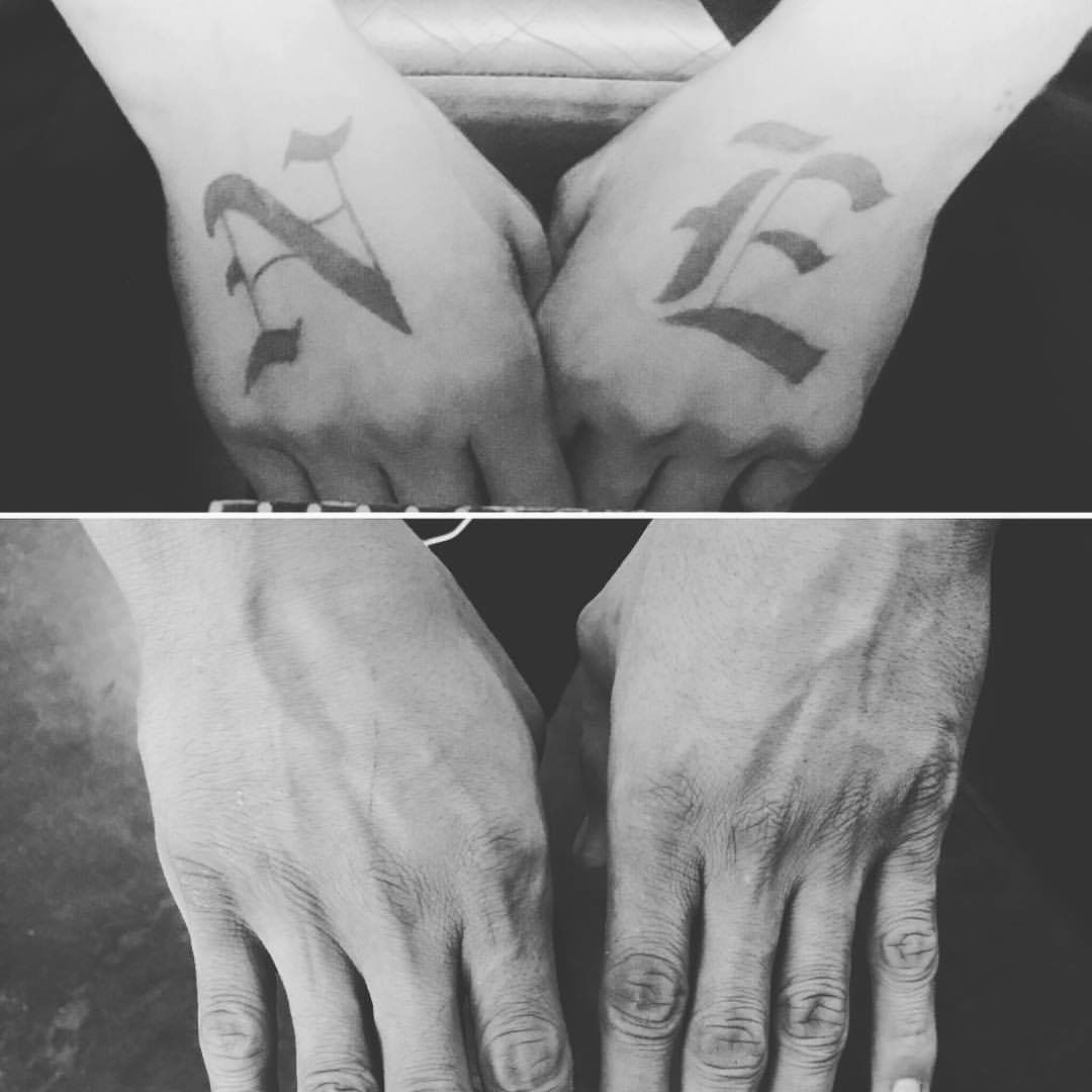 hand tattoo removal