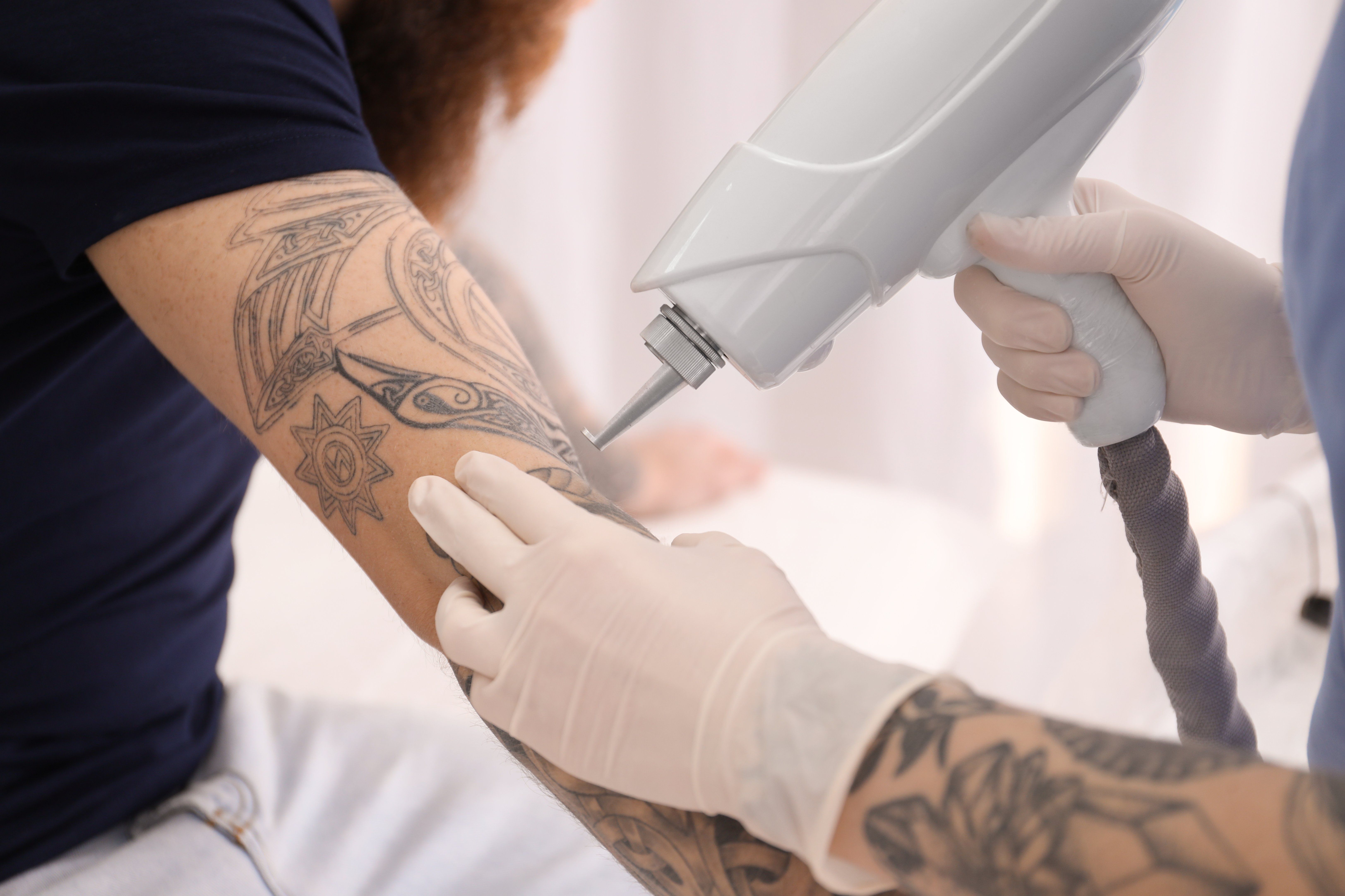 What to Look for in a Laser Tattoo Removal Clinic