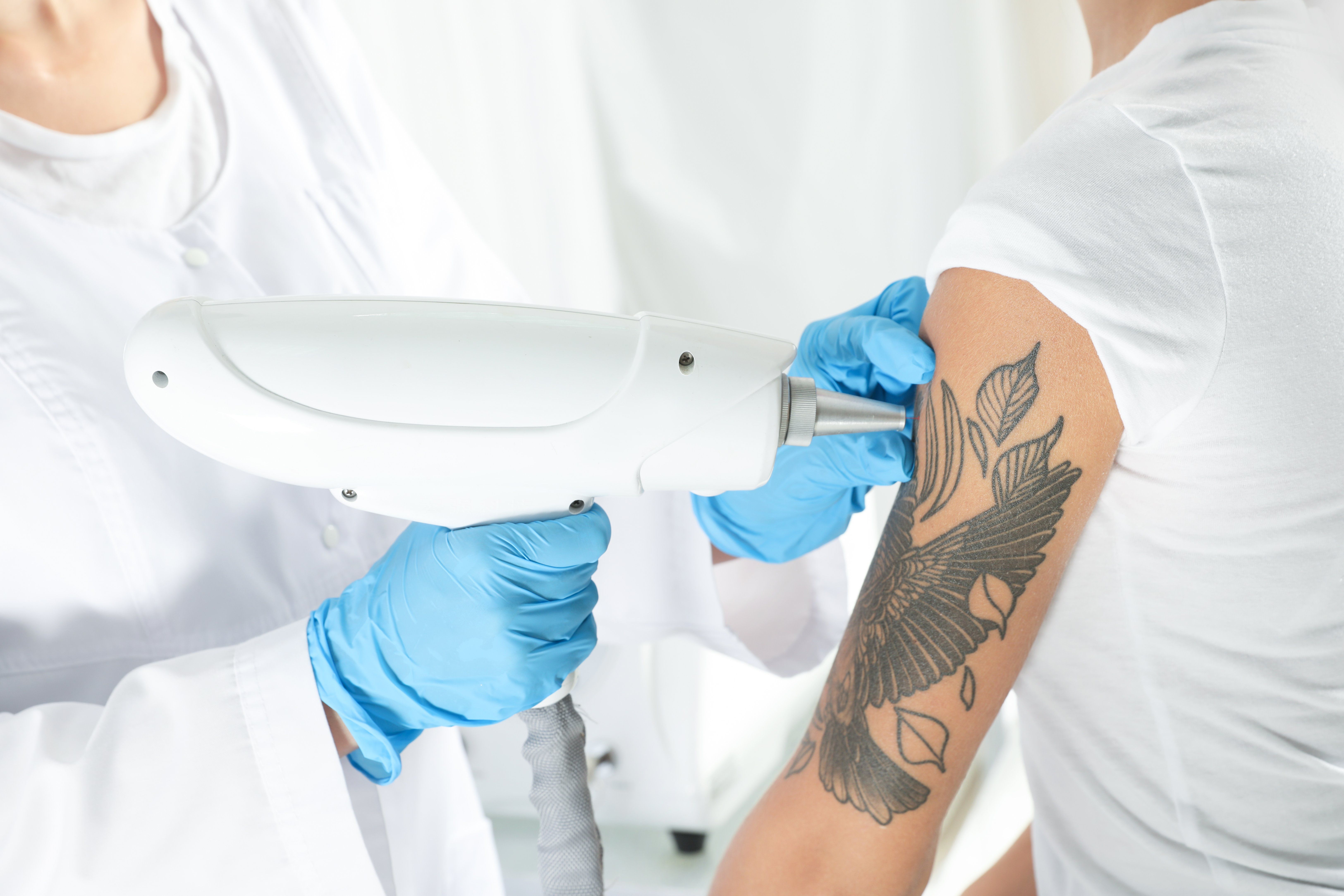 How To Avoid Scarring With Tattoo Removal?