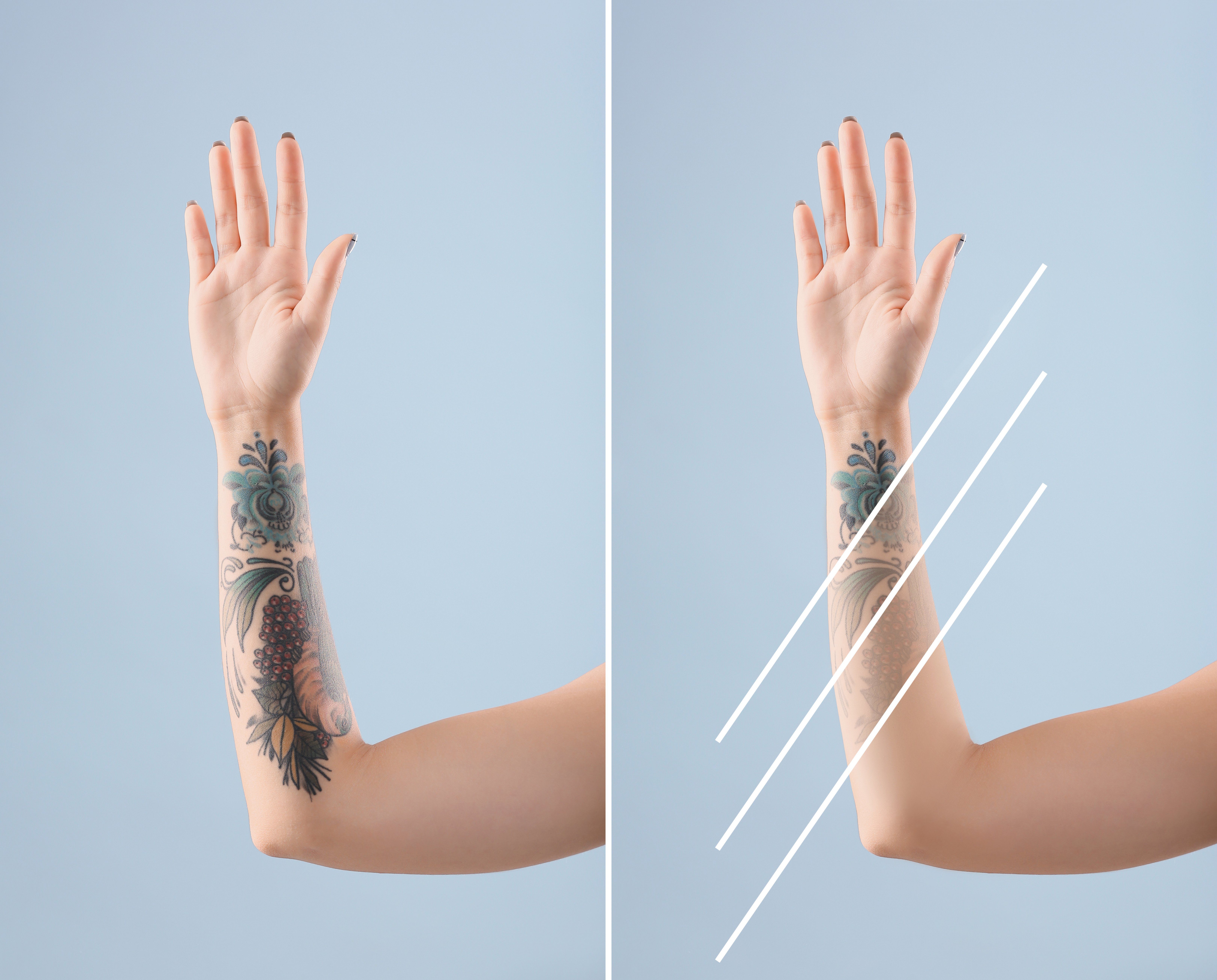 Best Tattoo Removal Laser: PicoWay® vs. PicoSure®