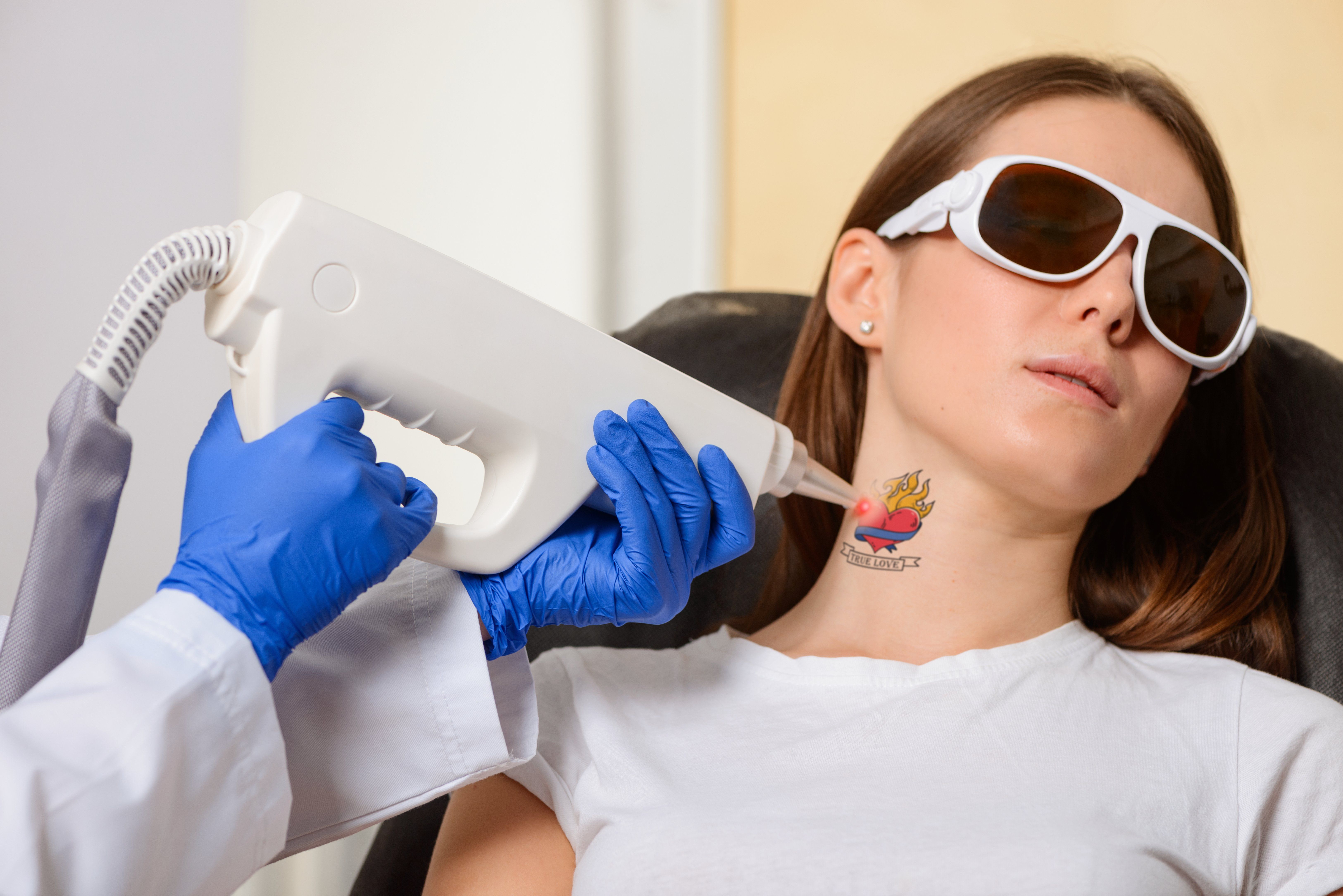 Tips for Managing Pain During Tattoo Removal