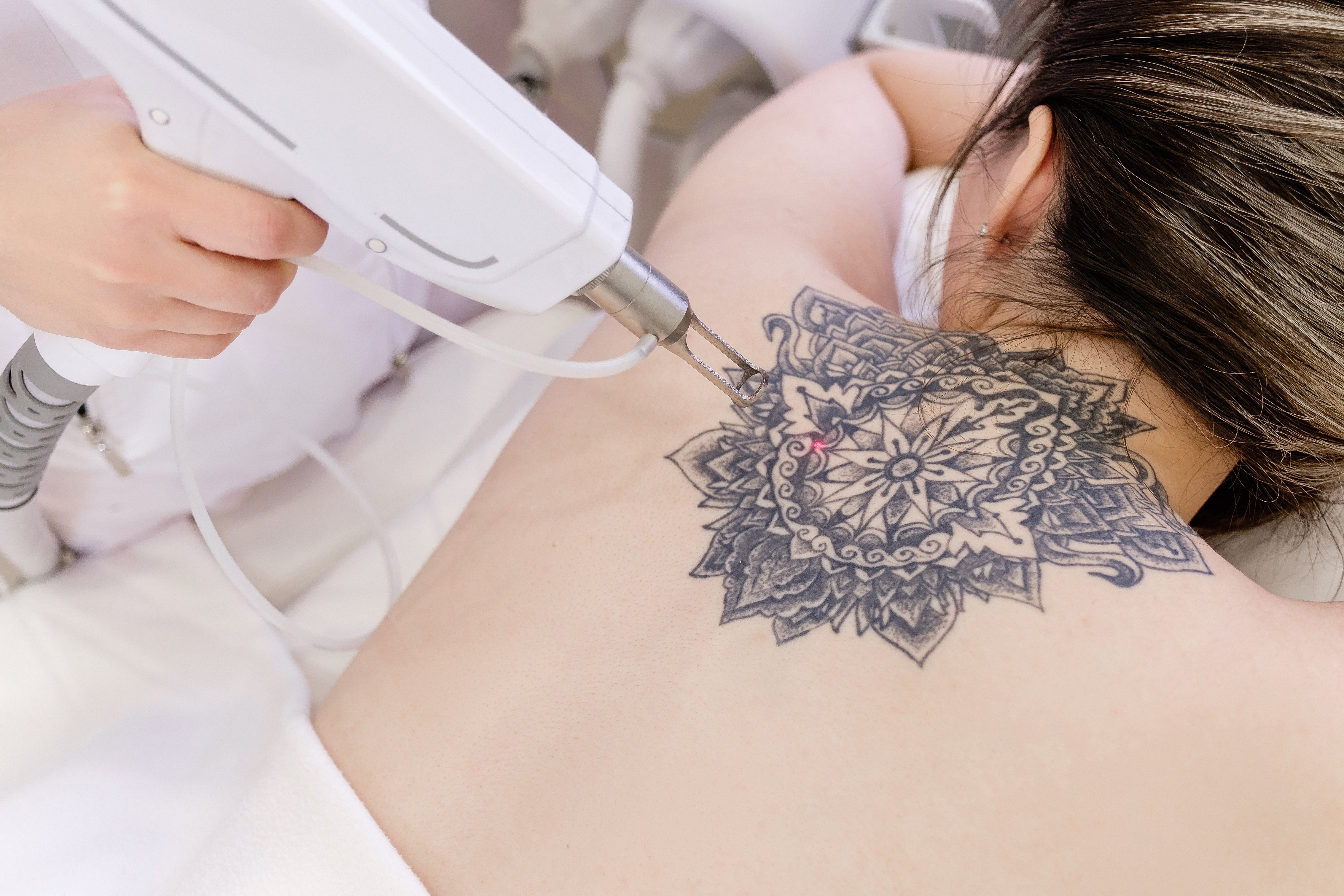 What to Expect From Laser Tattoo Removal