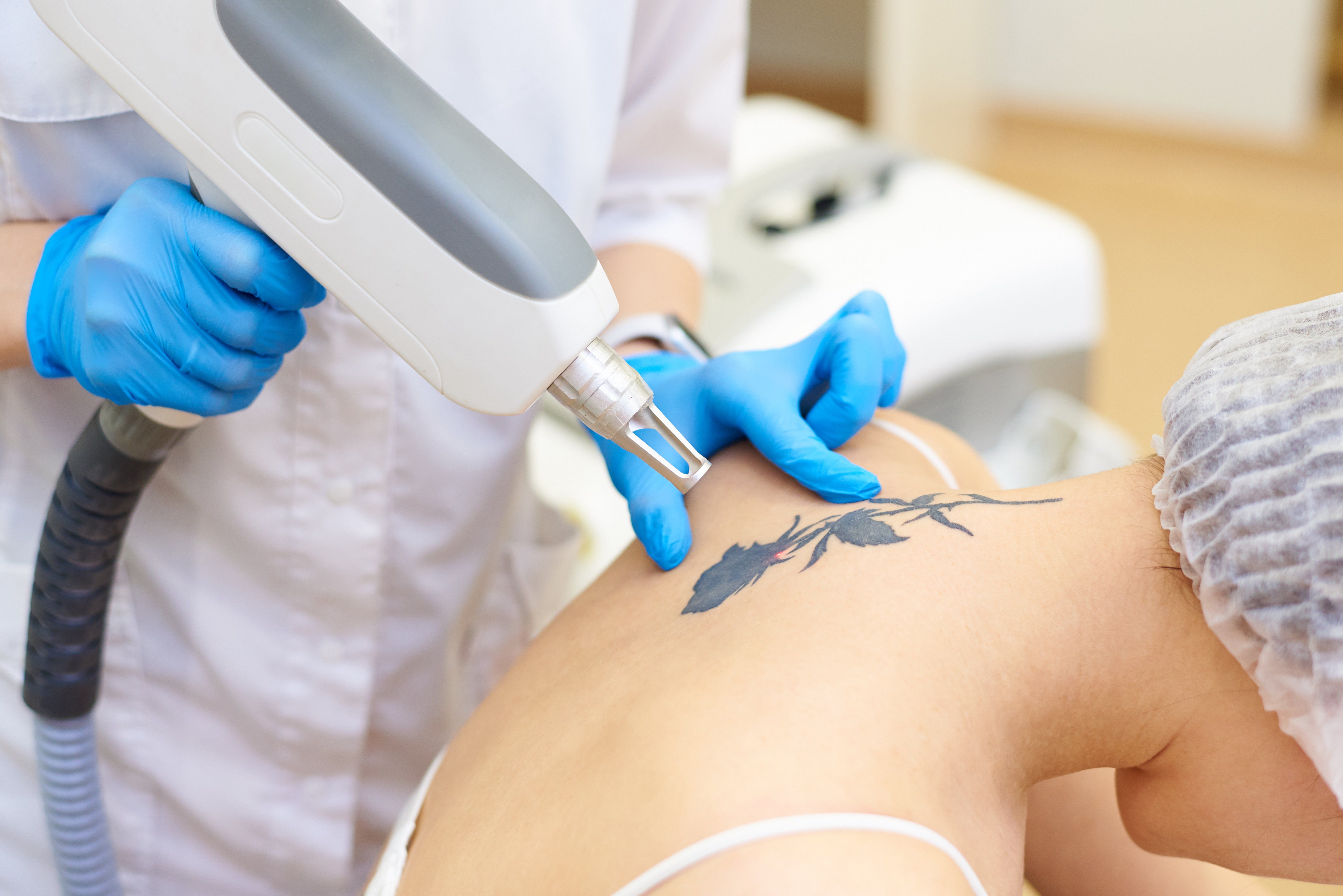 How Many Tattoo Removal Sessions Do You Need Based on Size?