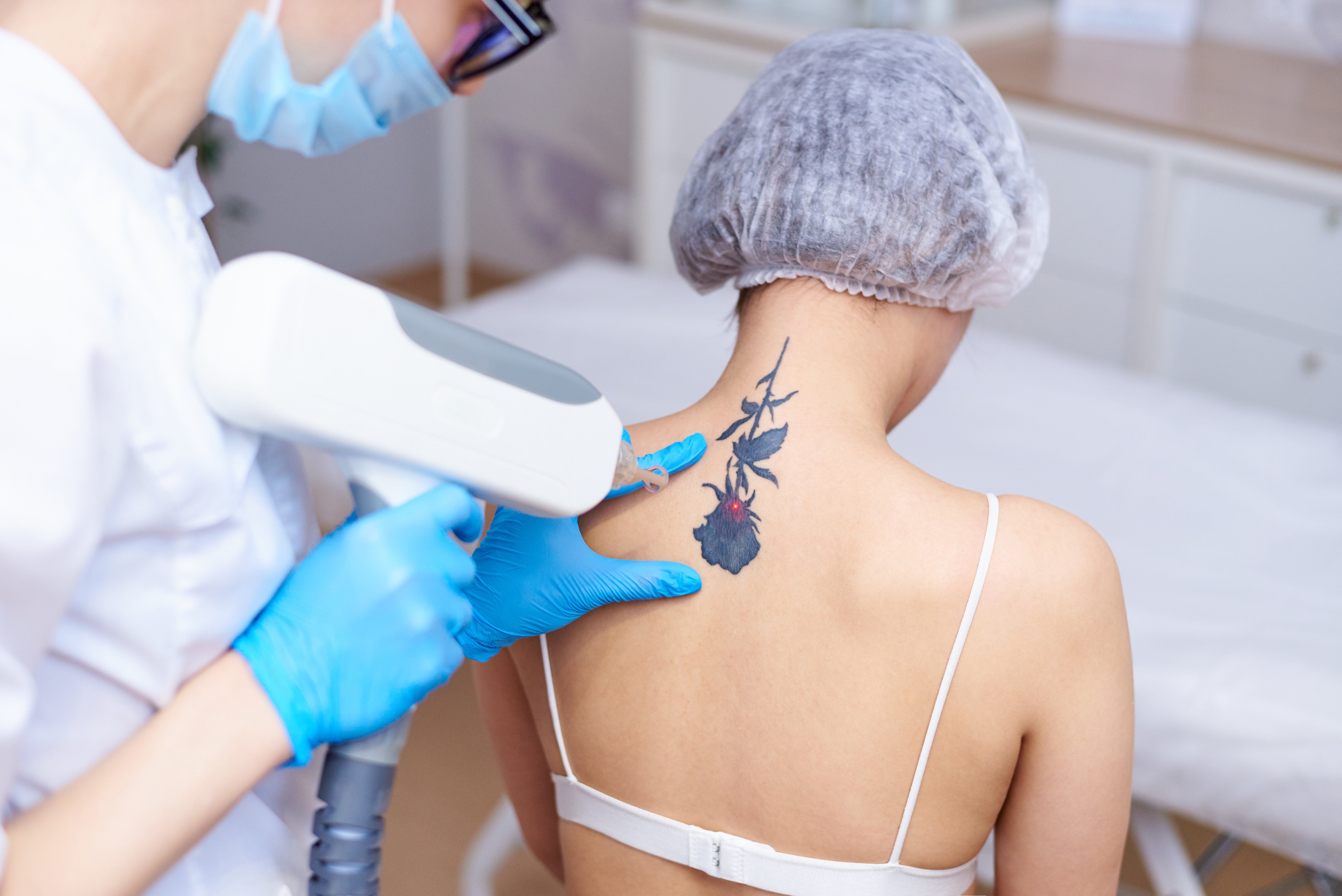10 Interesting Facts About Laser Tattoo Removal
