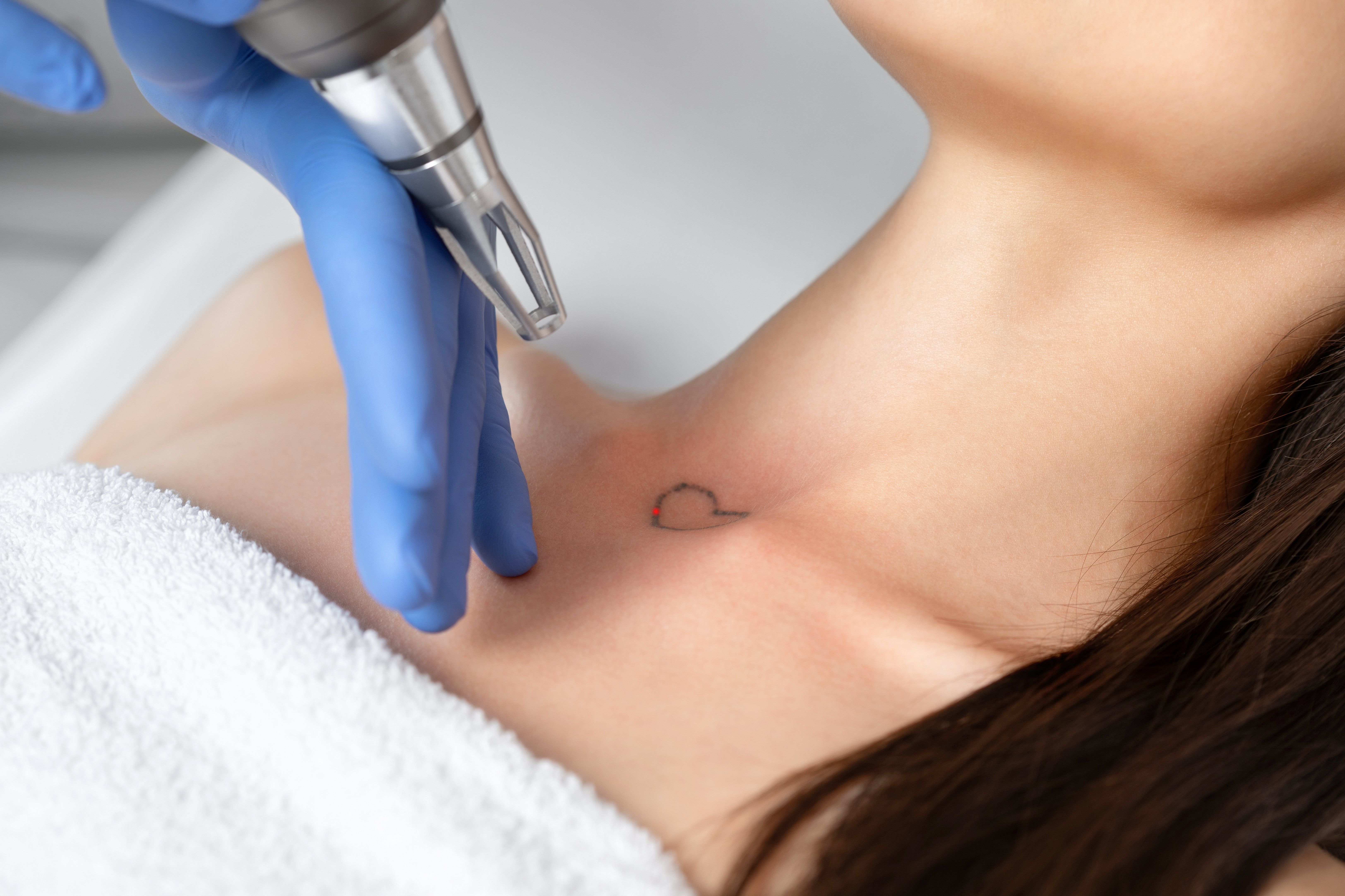 Will Tattoo Removal Be Easier in the Future?