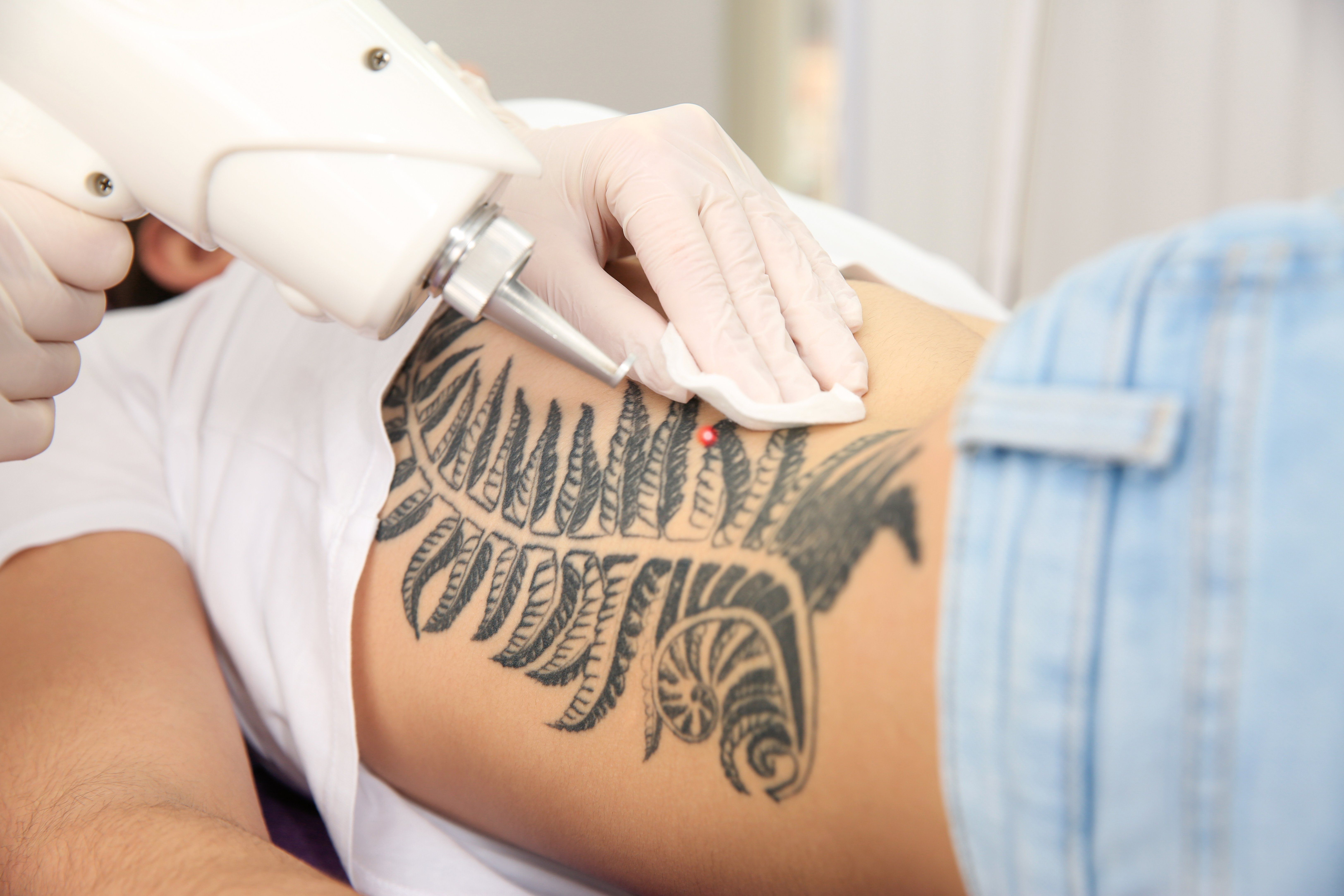 Will Laser Tattoo Removal Leave a Scar?