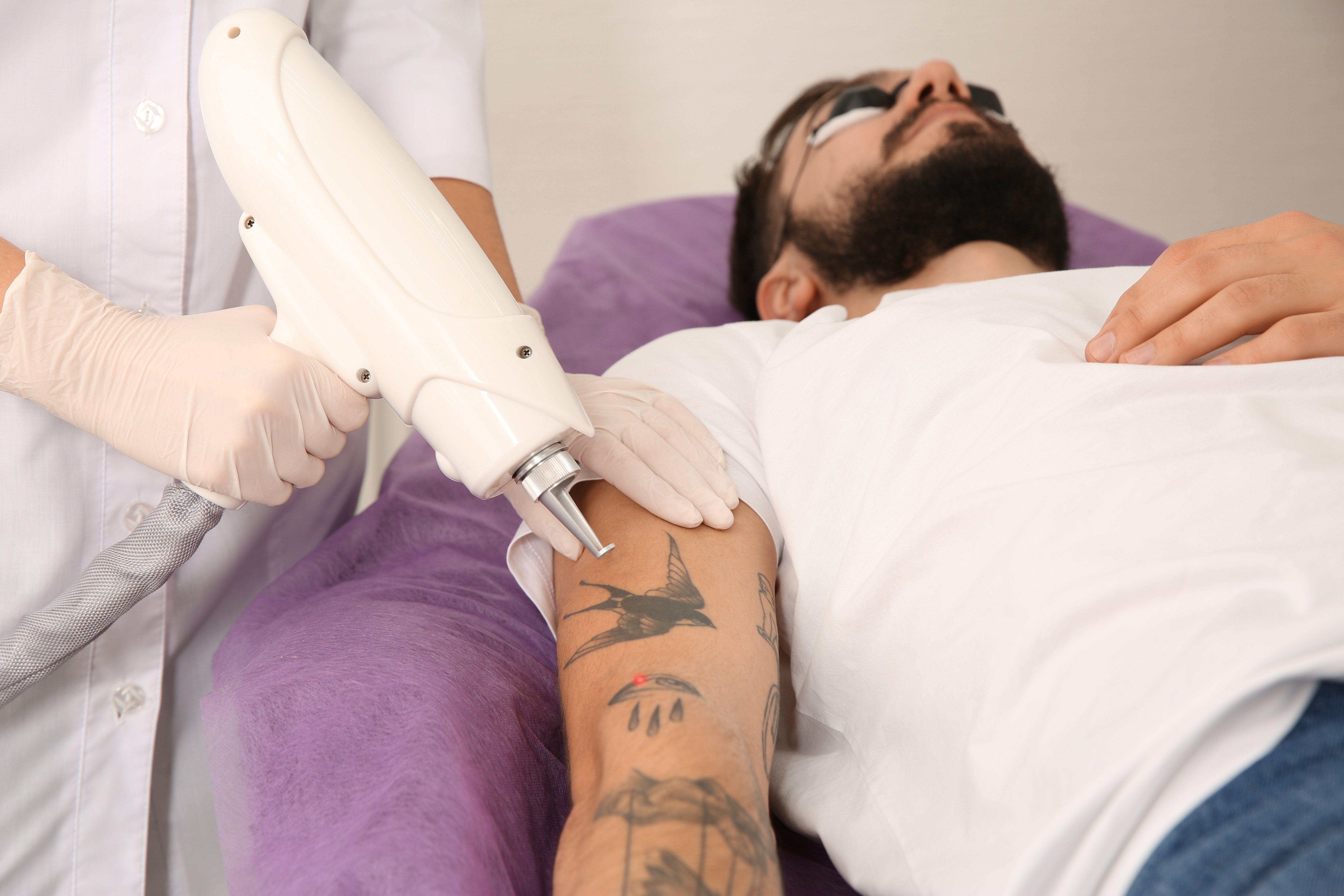 How Many Sessions Are Usually Required for Tattoo Removal?