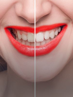 Teeth Whitening