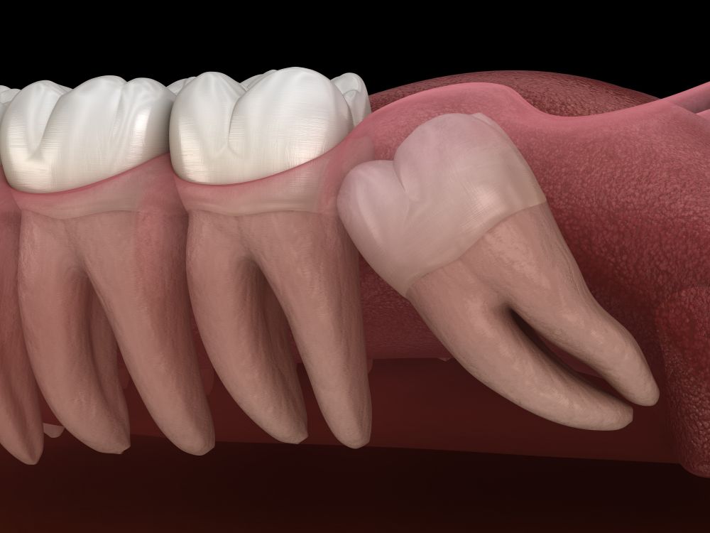 Key Questions About Wisdom Teeth Removal