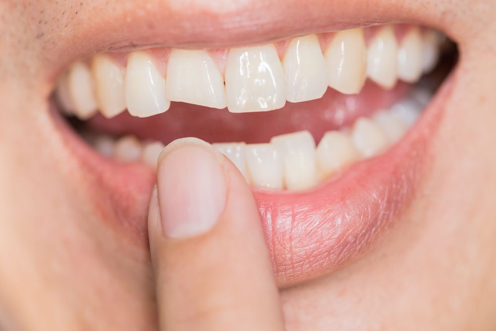 What Can Cause a Tooth to Crack?
