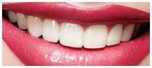 dental veneers results