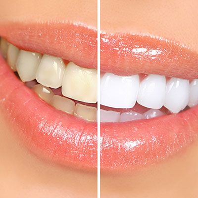 teeth whitening