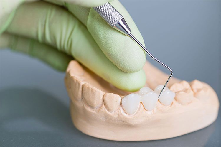 dental inlays