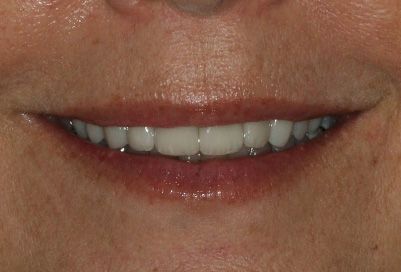 teeth whitening from veneers