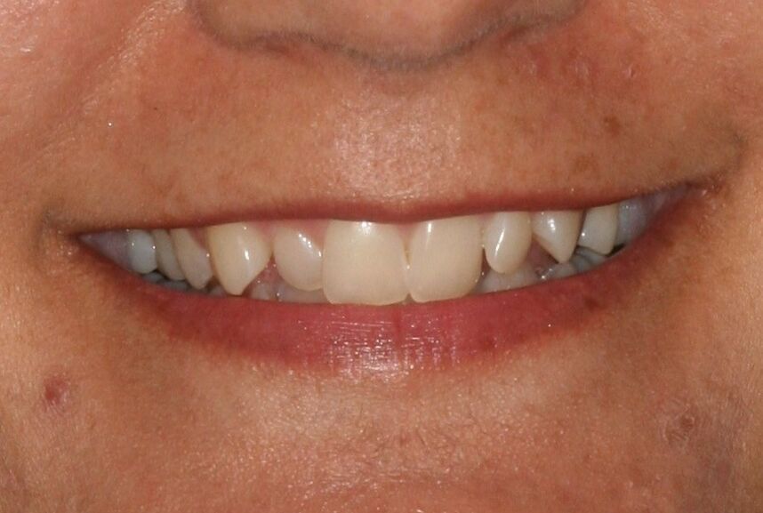 after 6 months smile