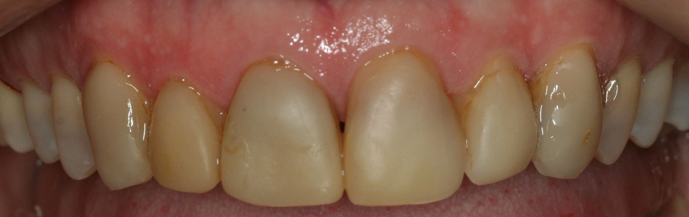 discolored teeth