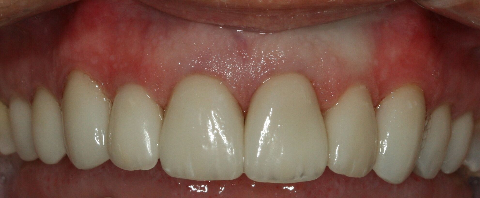 whiter teeth from veneers