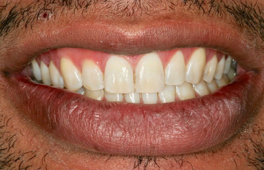 after veneers