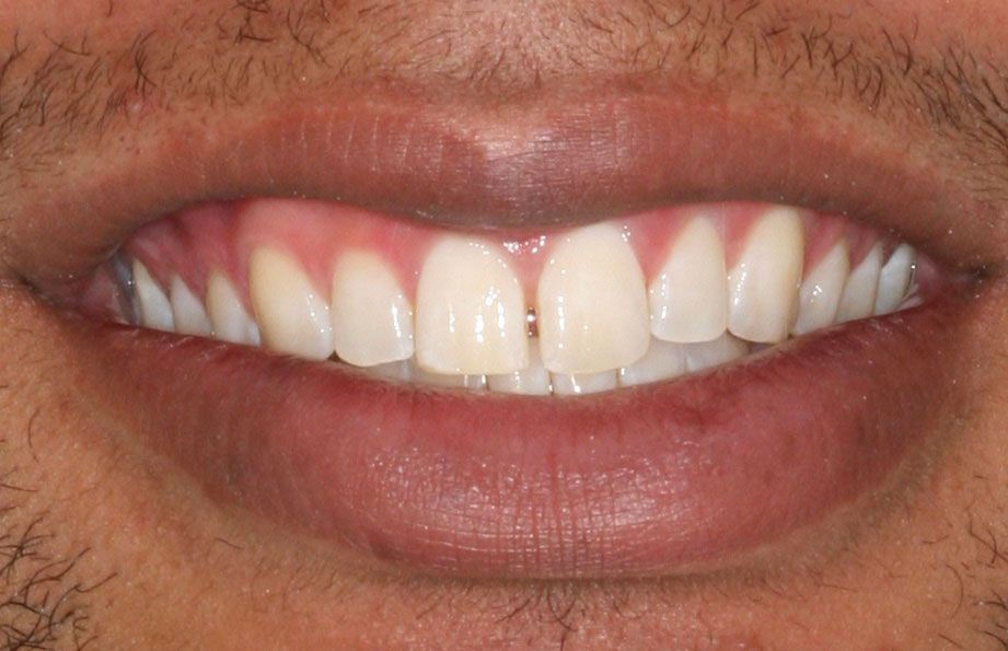 before closing veneers