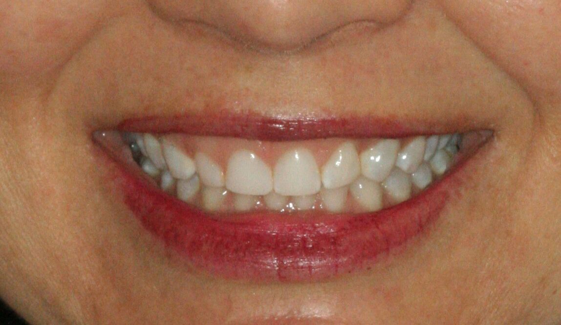 before veneers