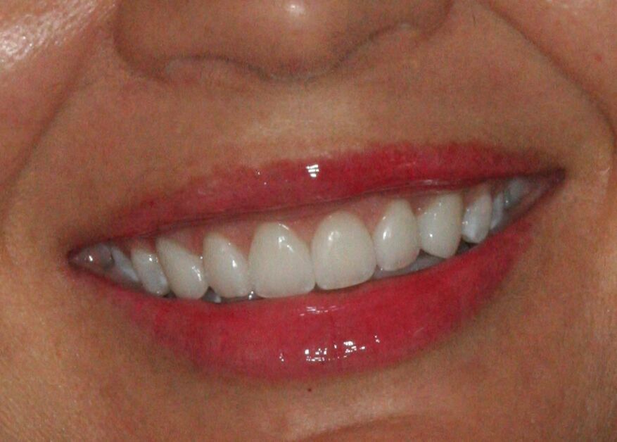 after porcelain veneers