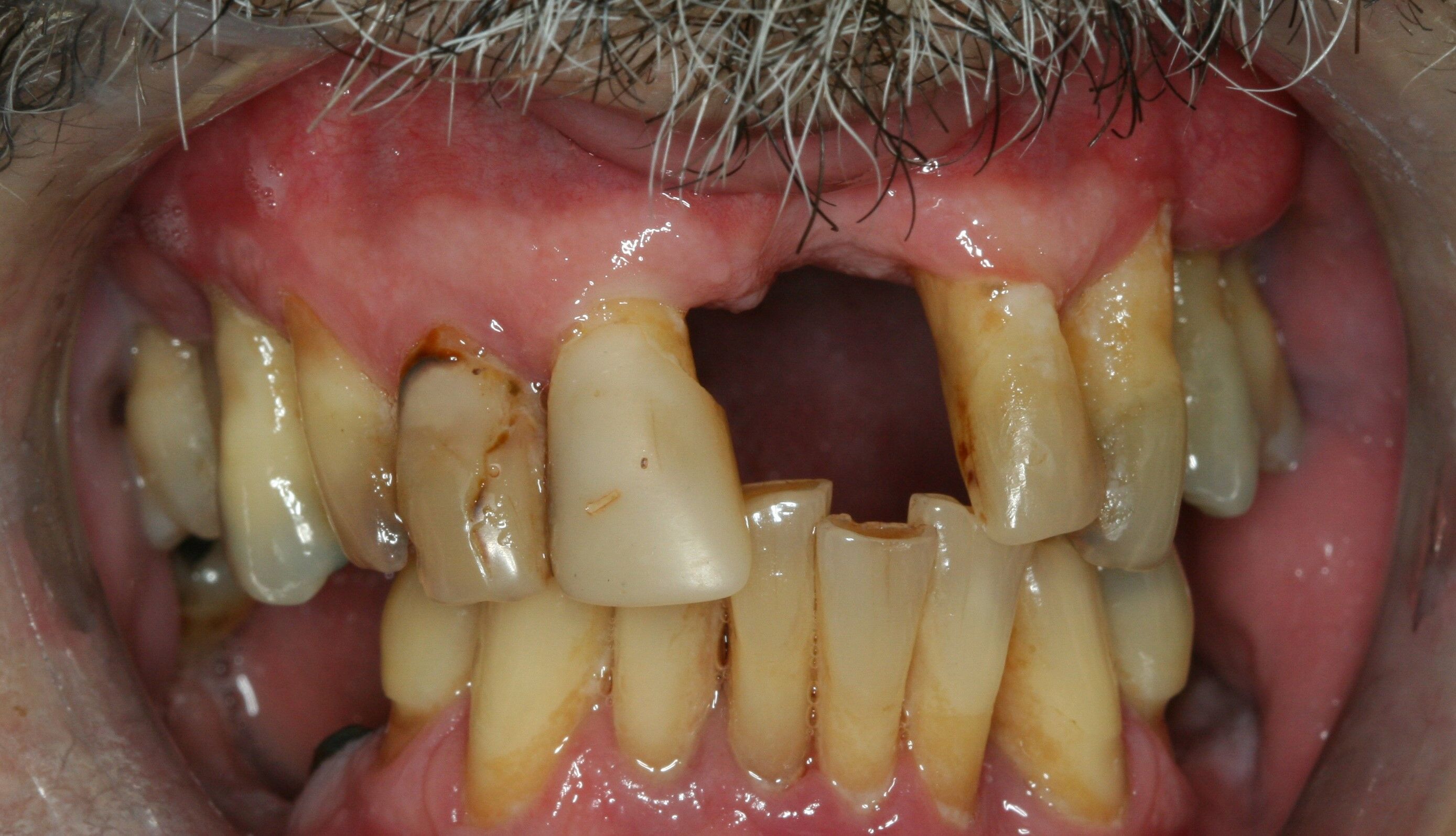 missing teeth