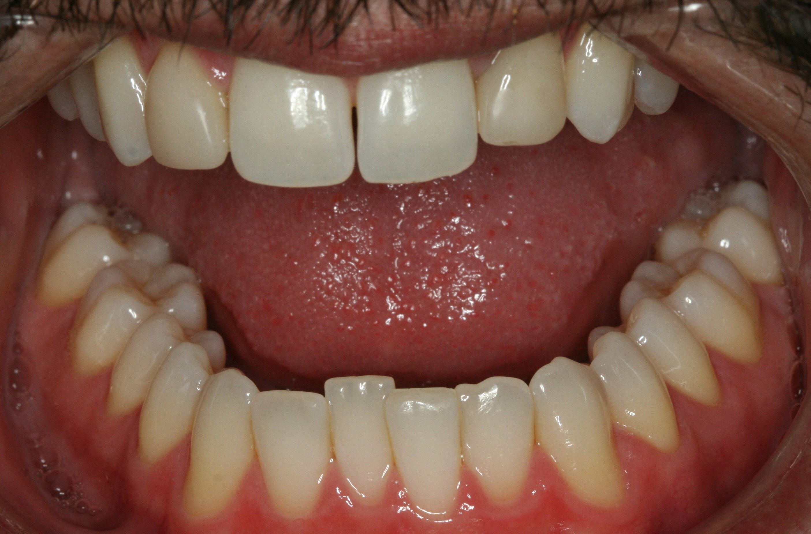 after veneers