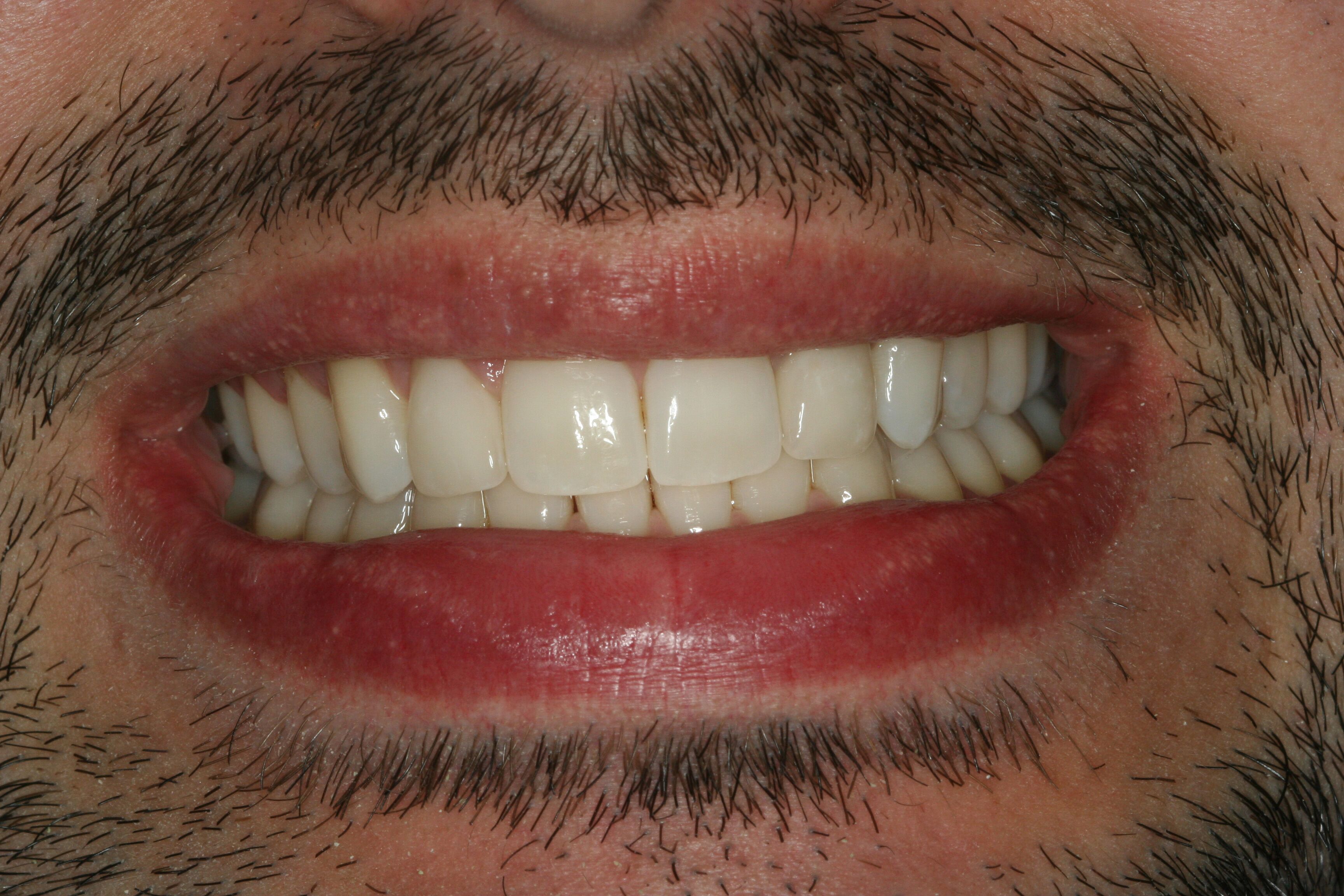 after veneers