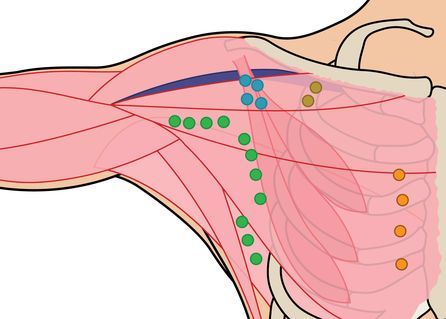 Breast Cancer Lymph Node Surgery | Manhattan, NY