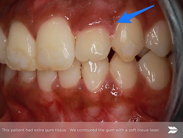 Gum Contouring in Arlington VA Before & After