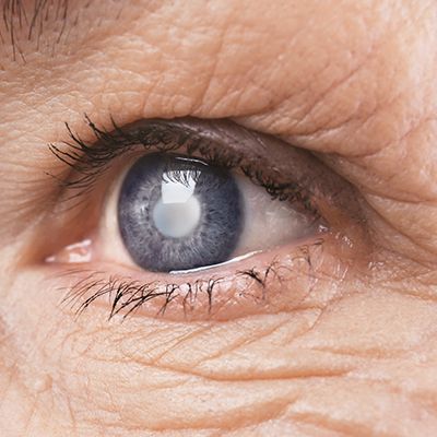 Cataracts