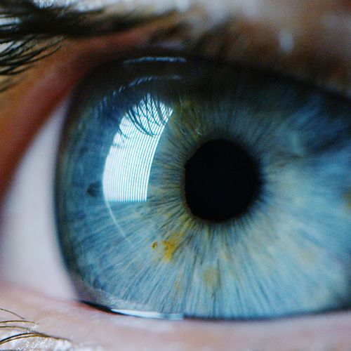 Retinal Detachment